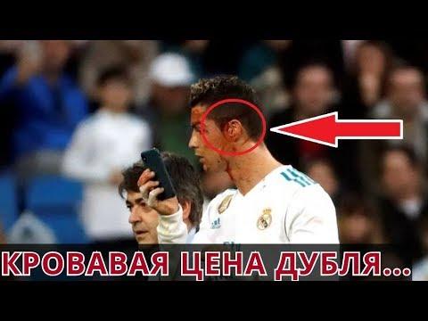 Роналду разбили лицо в матче с Депортиво. Цена дубля -кровь!!! Серьезная травма Криштиано?